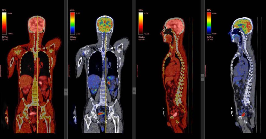 Does a PET scan detect cancer better than a CT scan