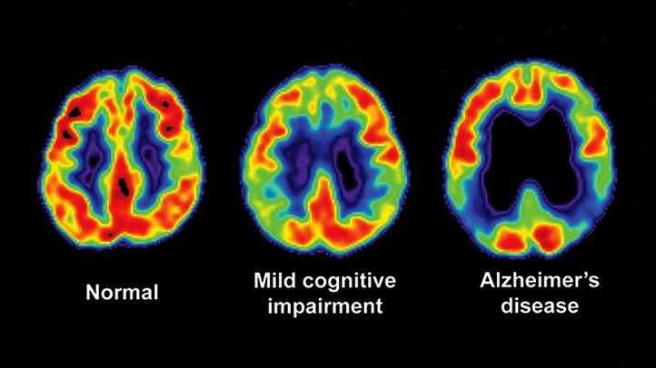 pet scan