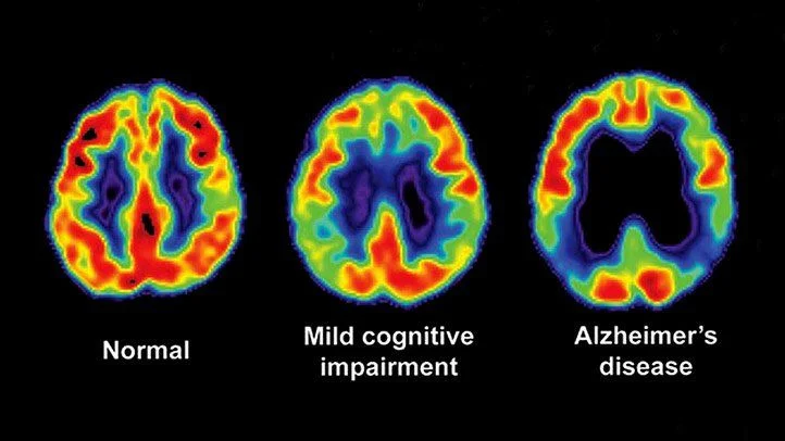 pet scan