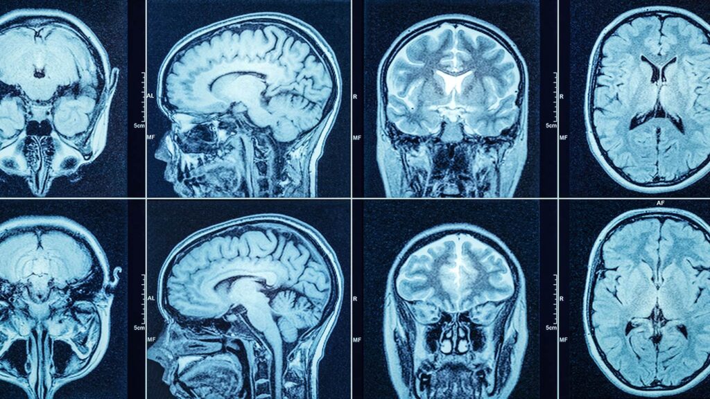 PET Scan And CT Scan Different