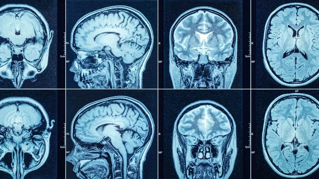 PET Scan And CT Scan Different