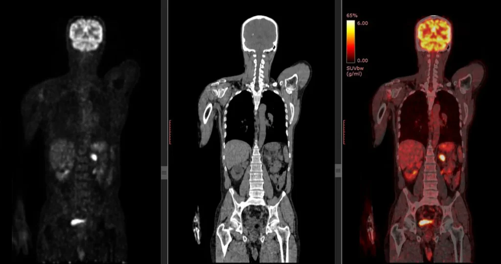 Screenshot 2025 03 21 213253 1024X540 - PET Scan Lucknow
