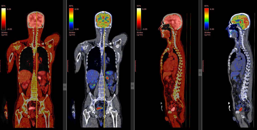 How to Reduce the Cost of a PET-CT Scan?