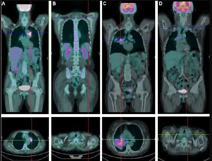 PET Scan Side Effects