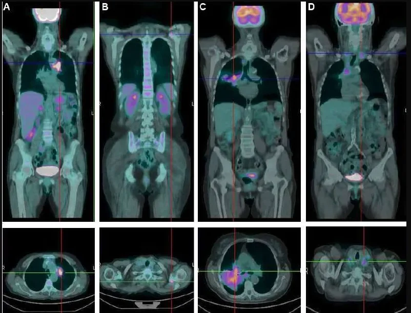 PET Scan Side Effects