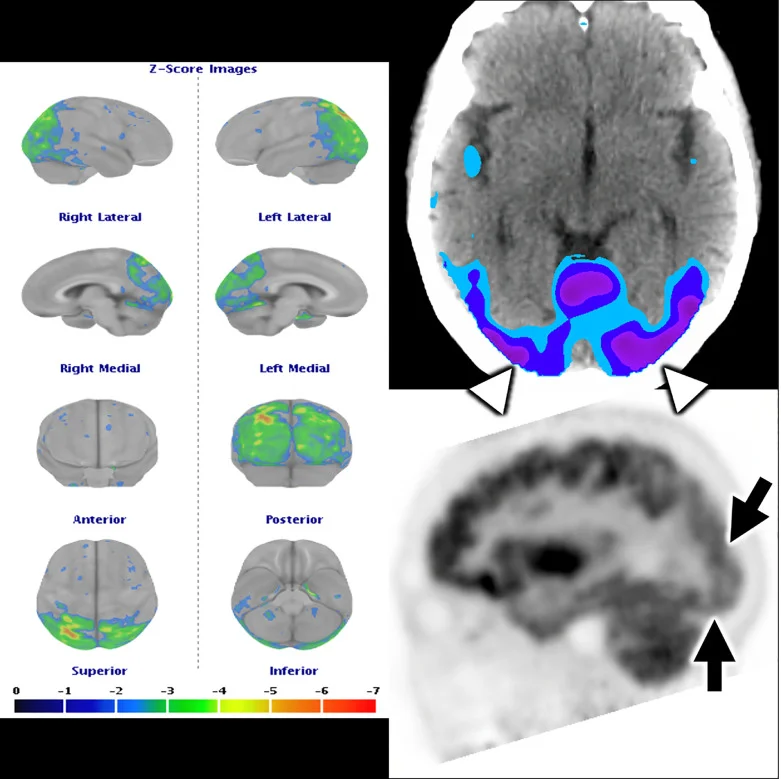 1 S2 - PET Scan Lucknow