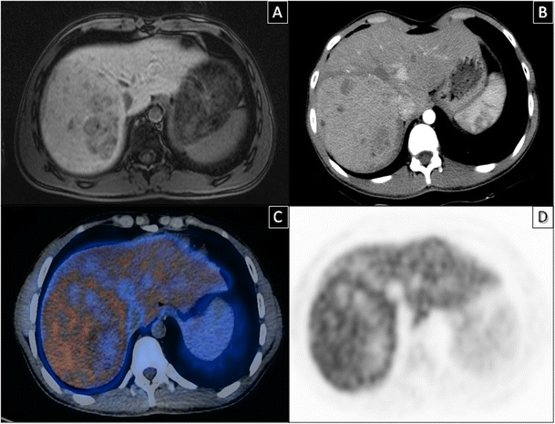 pet scan