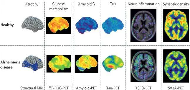 Diagnostic Scans For Dementia Healthy Brain Vs - PET Scan Lucknow