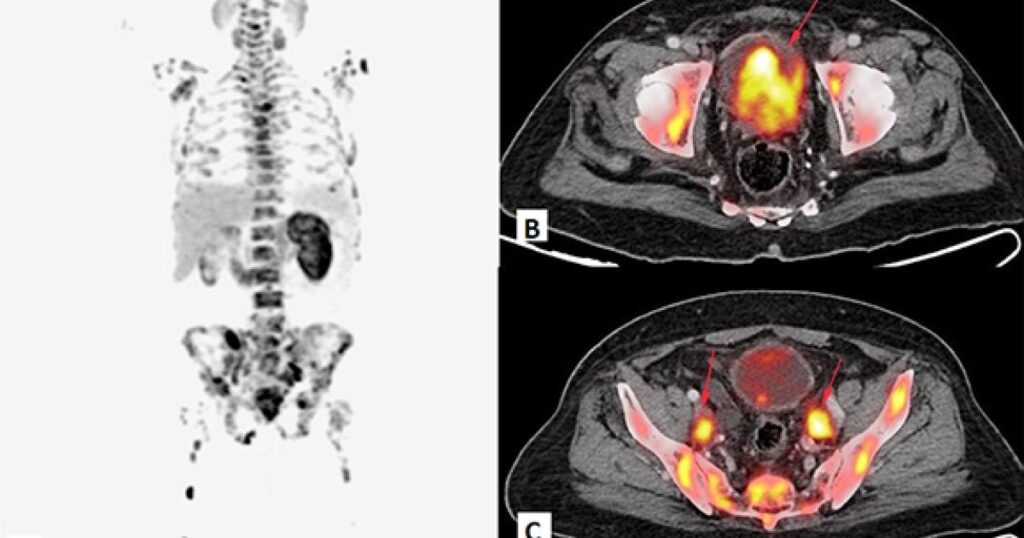 What Is PSMA PET Scan