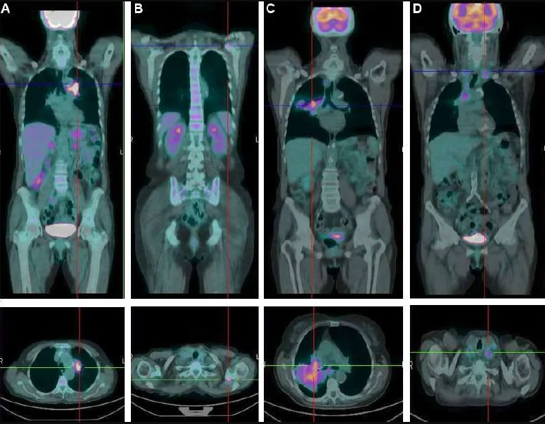 pet scan