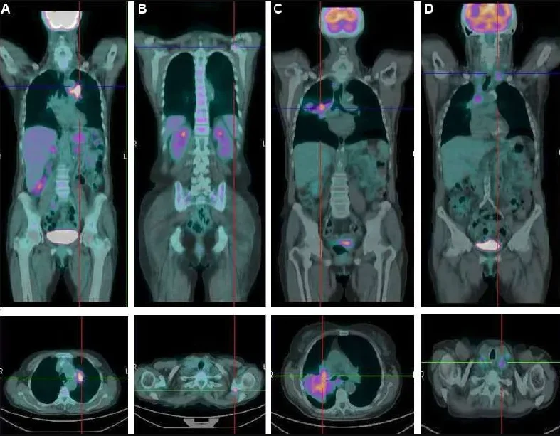 pet scan