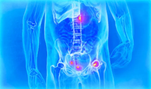 PET Scan for Prostate Cancer