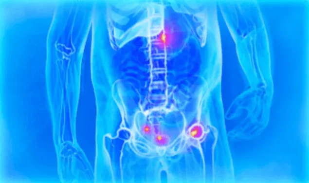 PET Scan for Prostate Cancer