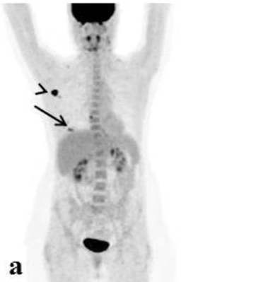 fdg scan
