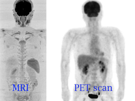 pet scan vs mri