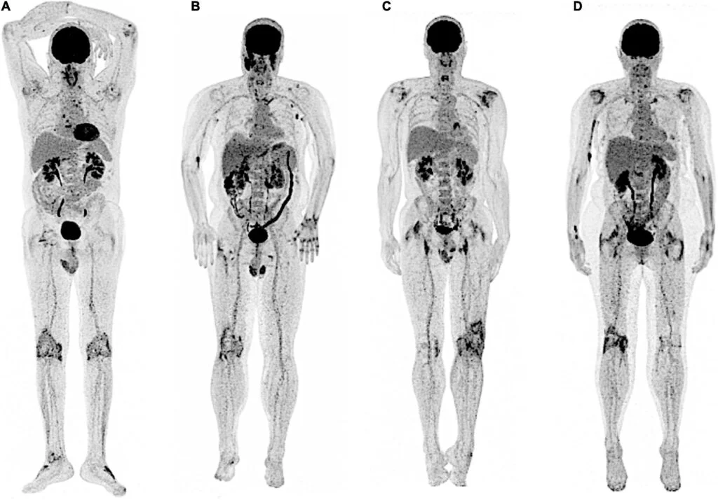 FDG PET Scan