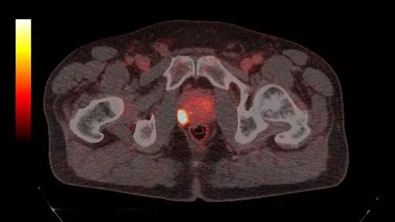 Psma Pet Image 2 - PET Scan Lucknow