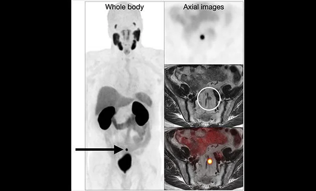 pet scan