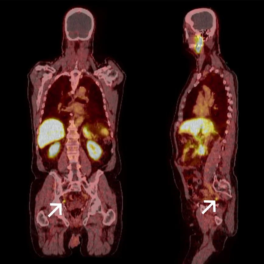 Psma Ganzer Koerper 79233623 6E4E3D30@724Ll - PET Scan Lucknow