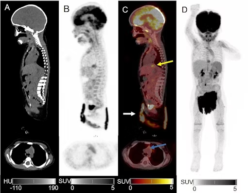 pet scan